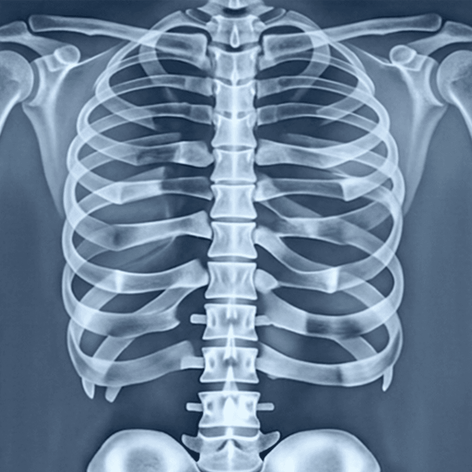 X-ray 검사